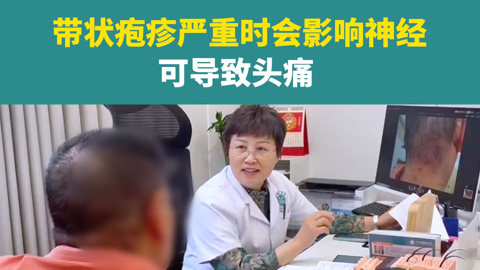 带状疱疹严重时会影响神经可导致头疼