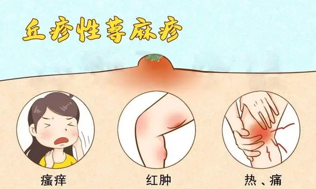 丘疹型荨麻疹.jpg 丘疹型荨麻疹.jpg